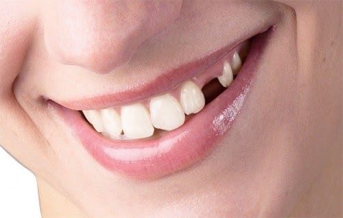 Giải mã giấc mơ bị gãy răng